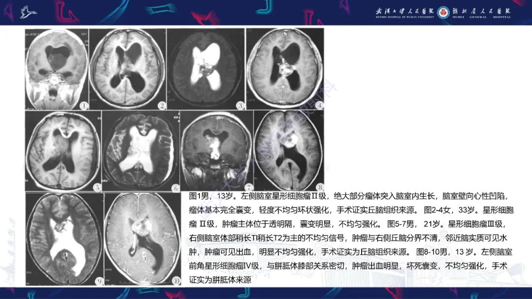 影像PPT - 【PPT】侧脑室肿瘤影像诊断-30