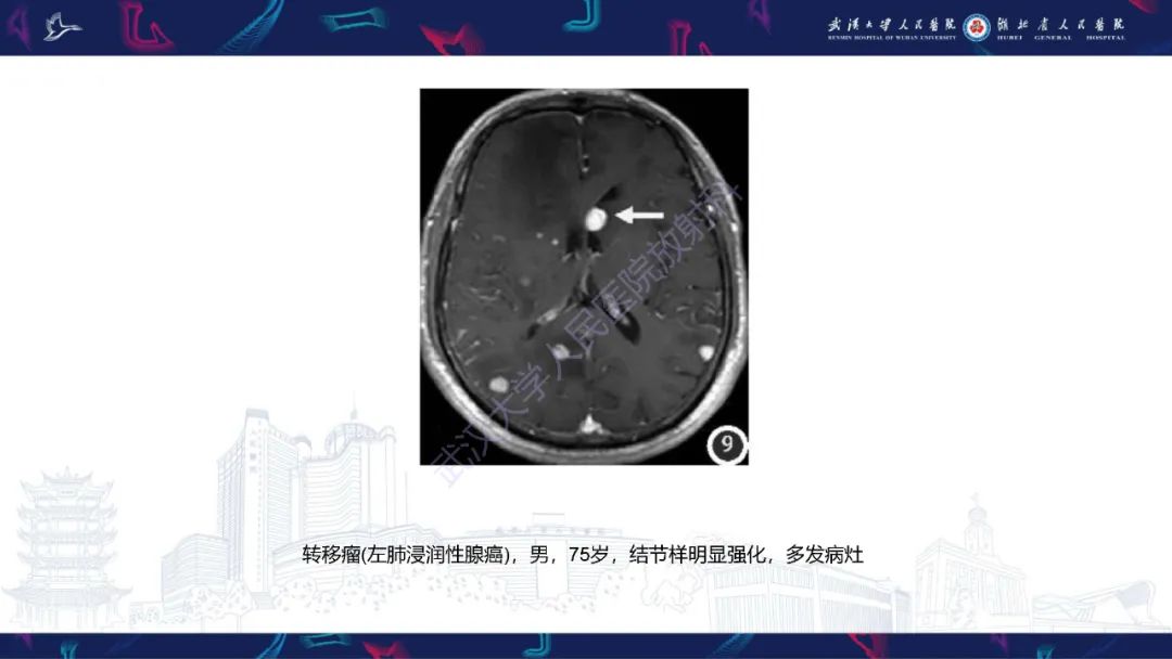 影像PPT - 【PPT】侧脑室肿瘤影像诊断-32
