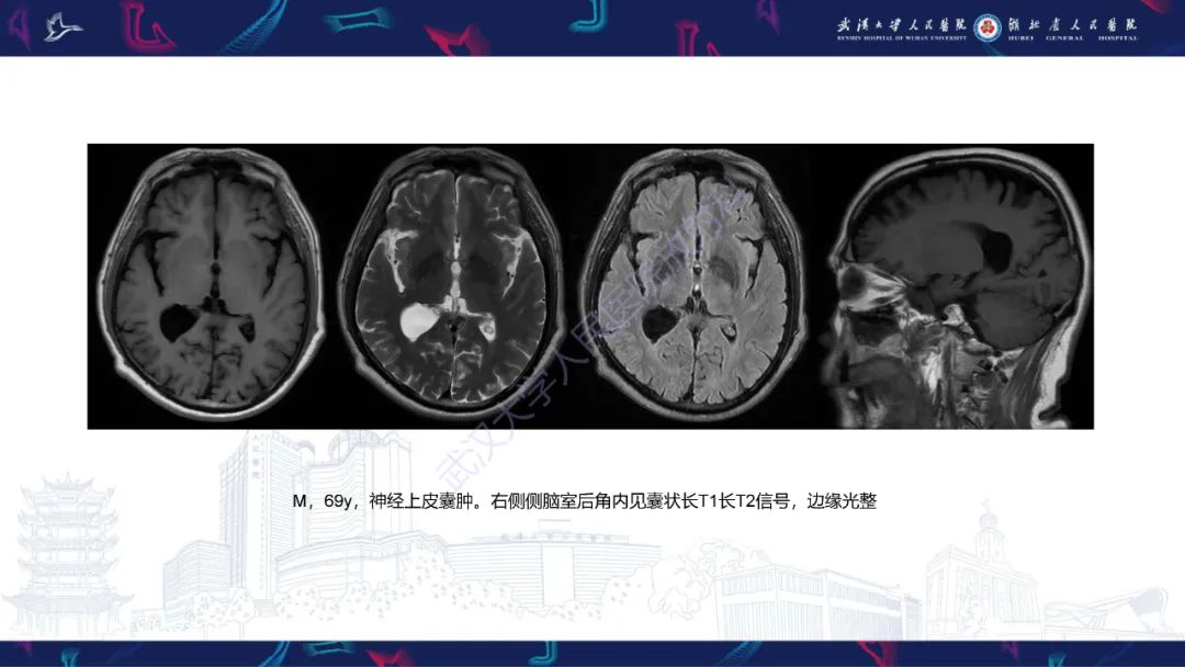 影像PPT - 【PPT】侧脑室肿瘤影像诊断-35