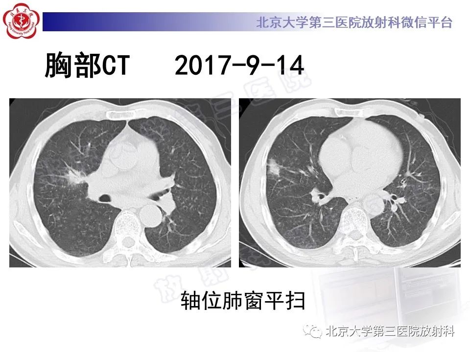 影像PPT - 【PPT】过敏性肺炎-5