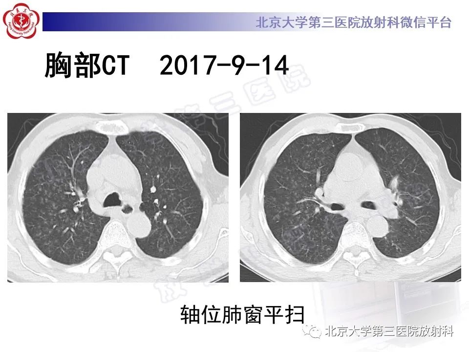 影像PPT - 【PPT】过敏性肺炎-4