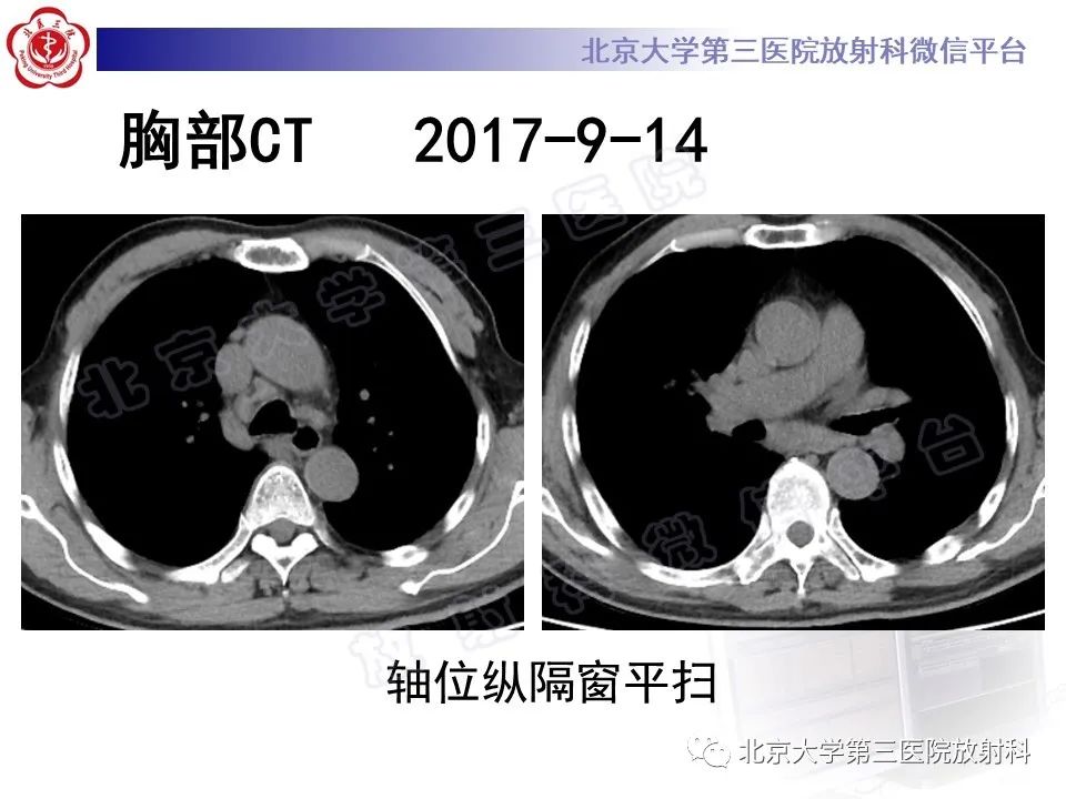 影像PPT - 【PPT】过敏性肺炎-6