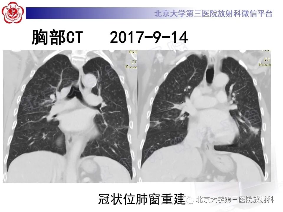 影像PPT - 【PPT】过敏性肺炎-7