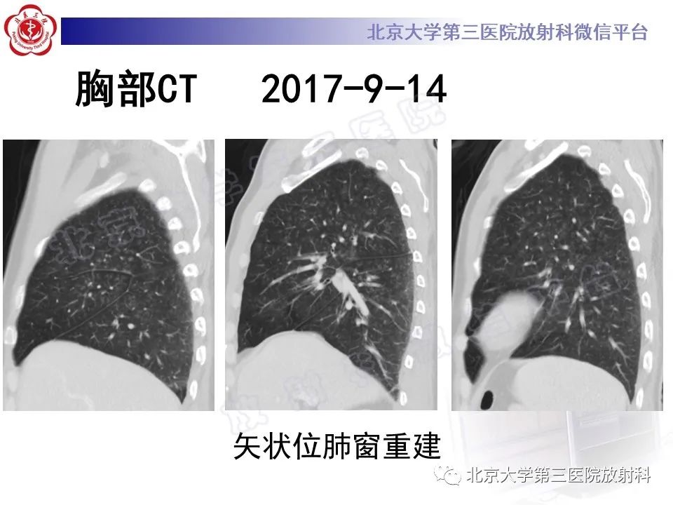 影像PPT - 【PPT】过敏性肺炎-8