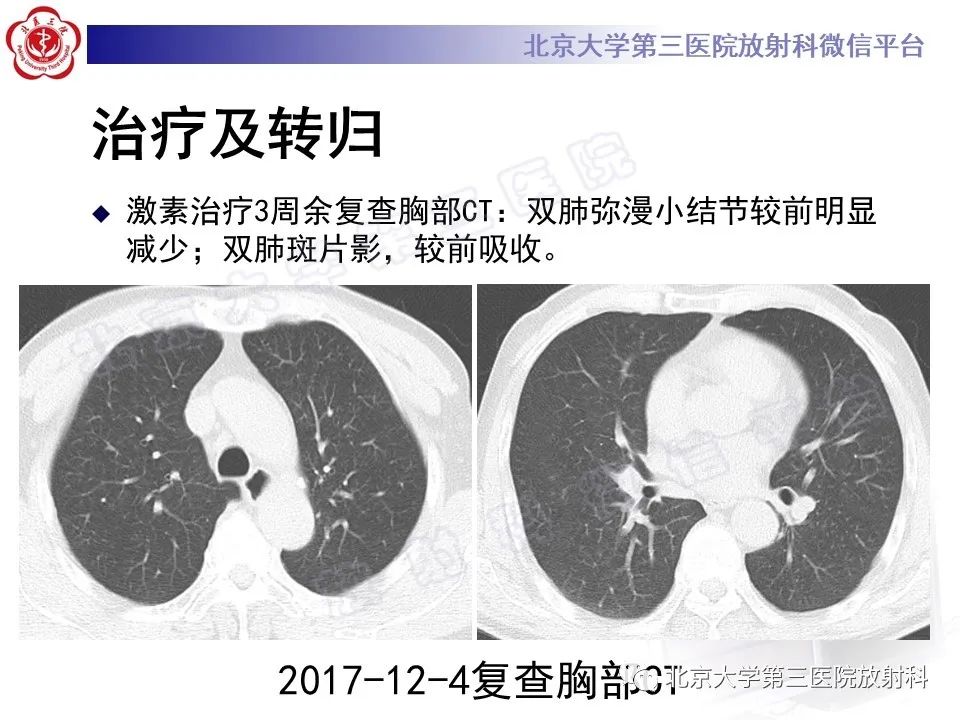 影像PPT - 【PPT】过敏性肺炎-10