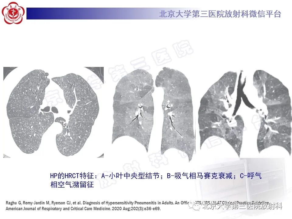 影像PPT - 【PPT】过敏性肺炎-18