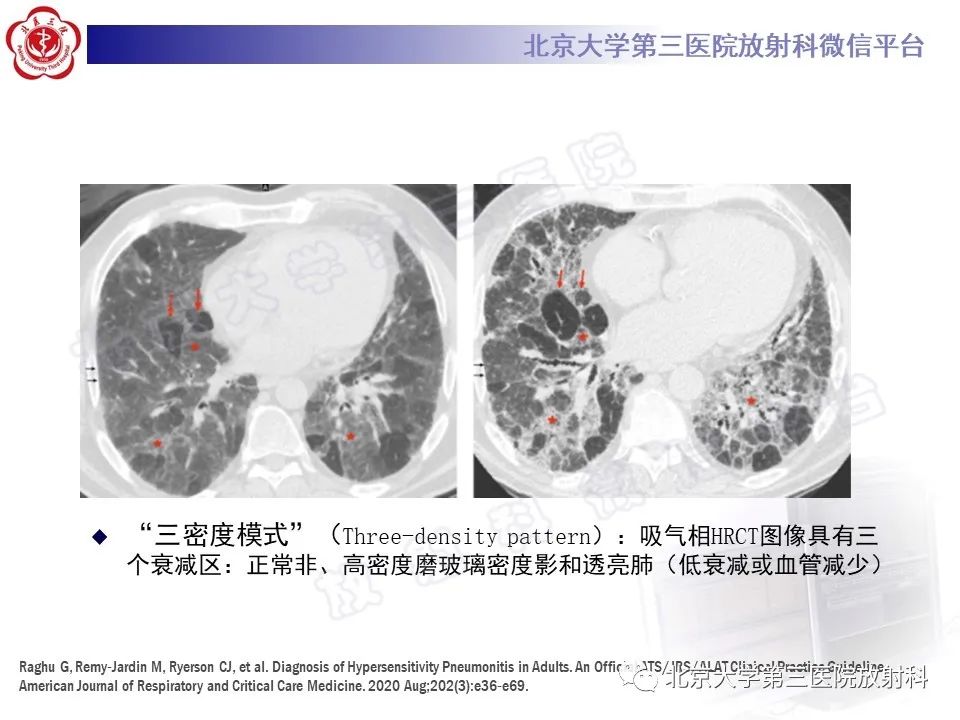 影像PPT - 【PPT】过敏性肺炎-19
