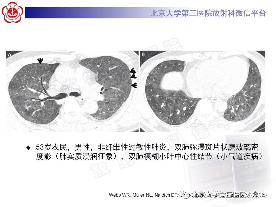 影像PPT - 【PPT】过敏性肺炎-20