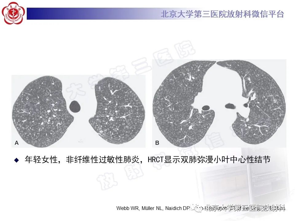 影像PPT - 【PPT】过敏性肺炎-21