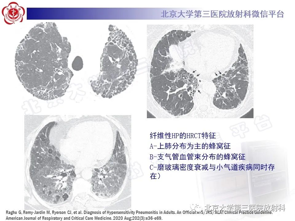 影像PPT - 【PPT】过敏性肺炎-24