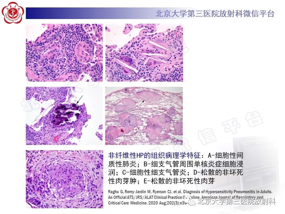 影像PPT - 【PPT】过敏性肺炎-28