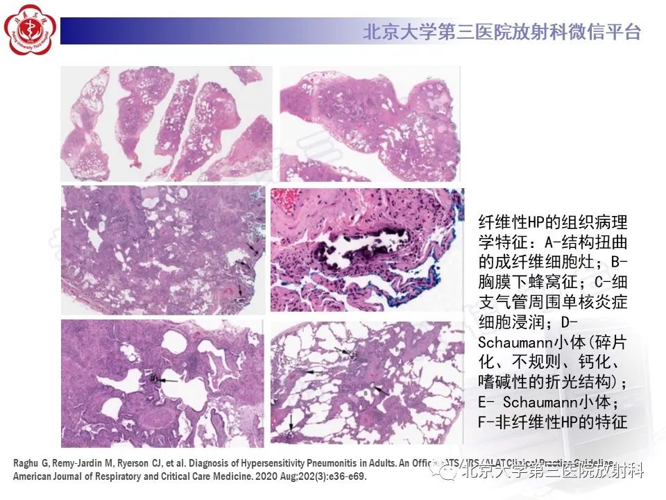 影像PPT - 【PPT】过敏性肺炎-30