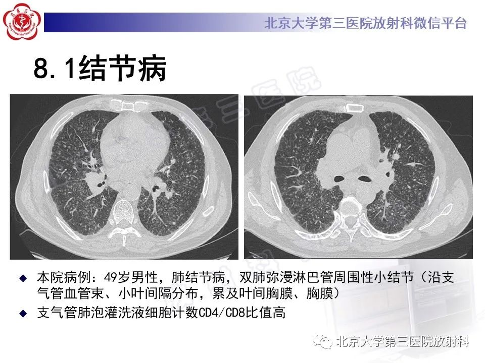 影像PPT - 【PPT】过敏性肺炎-34