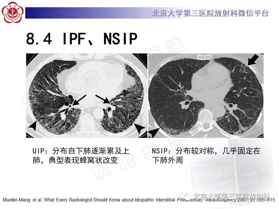影像PPT - 【PPT】过敏性肺炎-37
