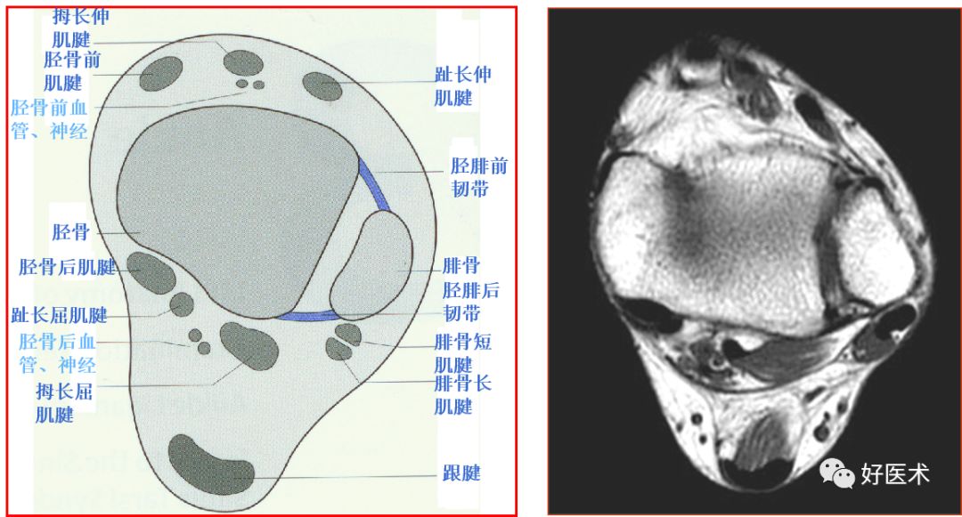影像PPT - 踝关节MRI解剖与常见病变-6 影像PPT - 踝关节MRI解剖与常见病变-6