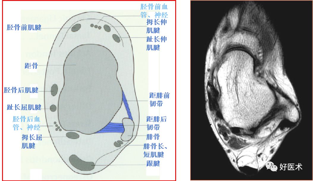 影像PPT - 踝关节MRI解剖与常见病变-7 影像PPT - 踝关节MRI解剖与常见病变-7