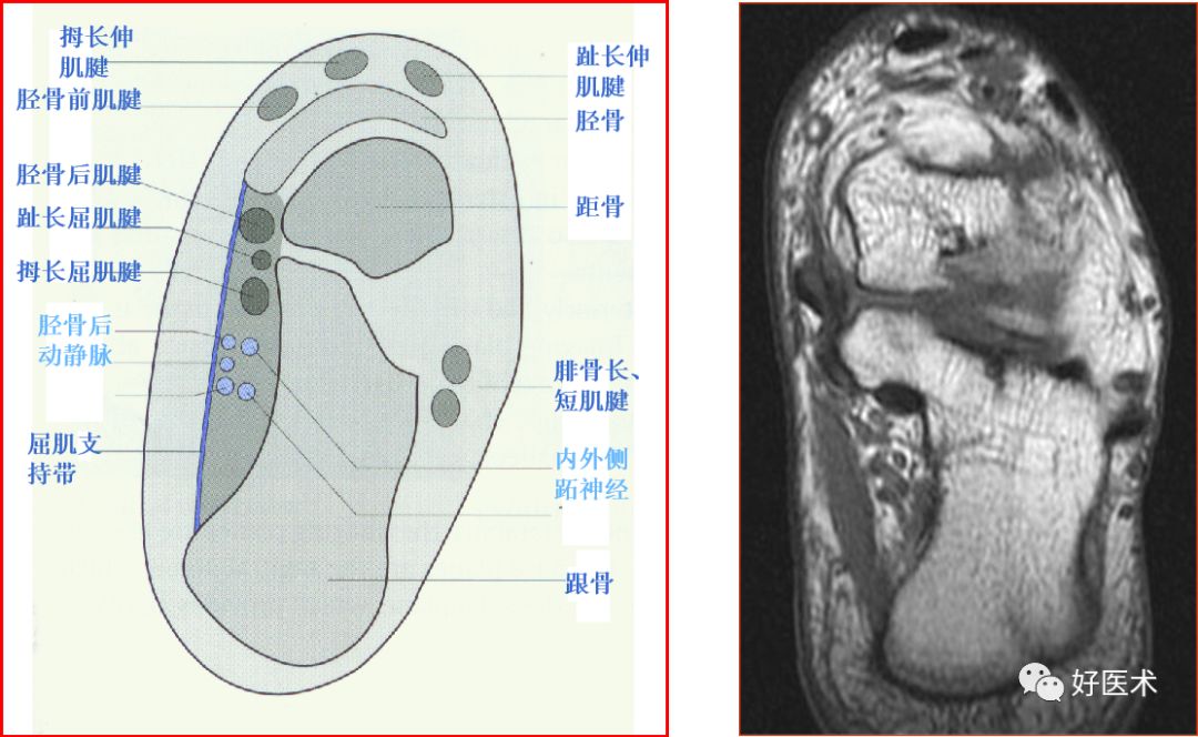 影像PPT - 踝关节MRI解剖与常见病变-8 影像PPT - 踝关节MRI解剖与常见病变-8