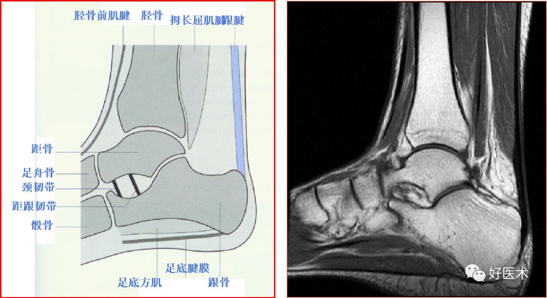 影像PPT - 踝关节MRI解剖与常见病变-9 影像PPT - 踝关节MRI解剖与常见病变-9