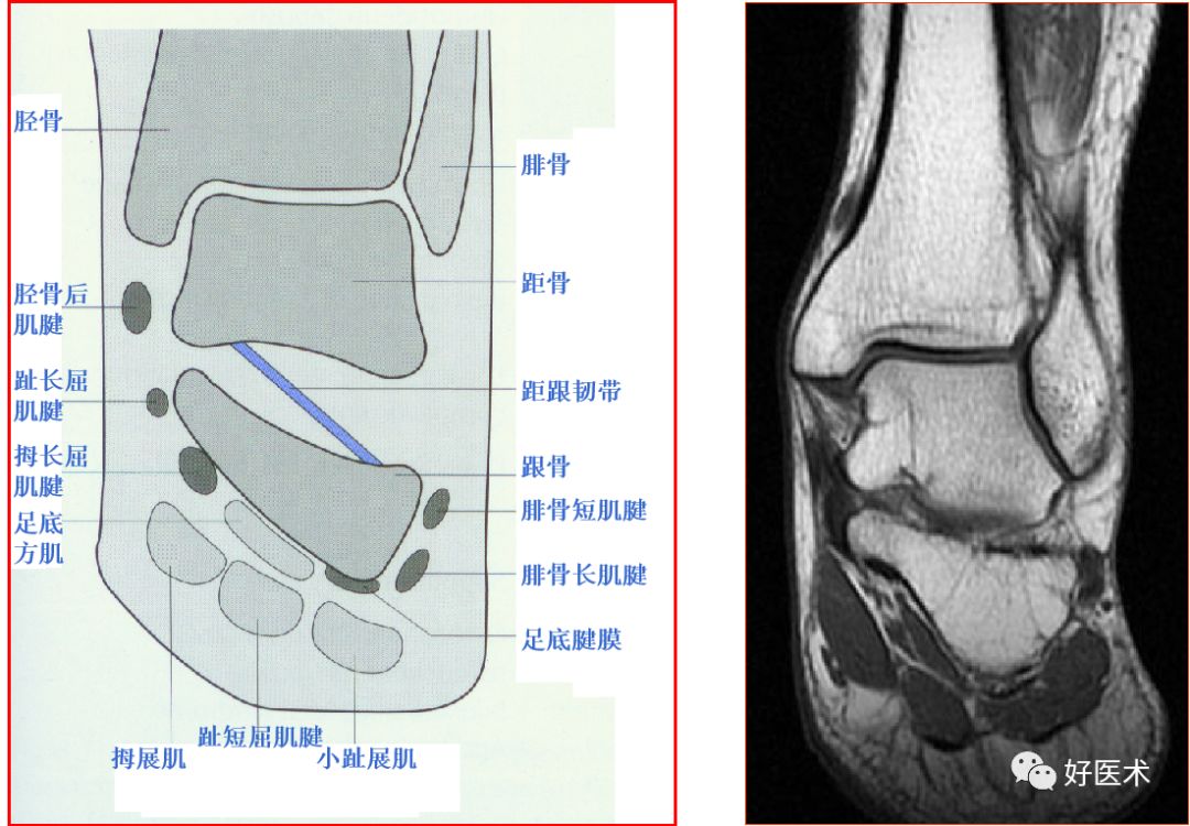 影像PPT - 踝关节MRI解剖与常见病变-10 影像PPT - 踝关节MRI解剖与常见病变-10