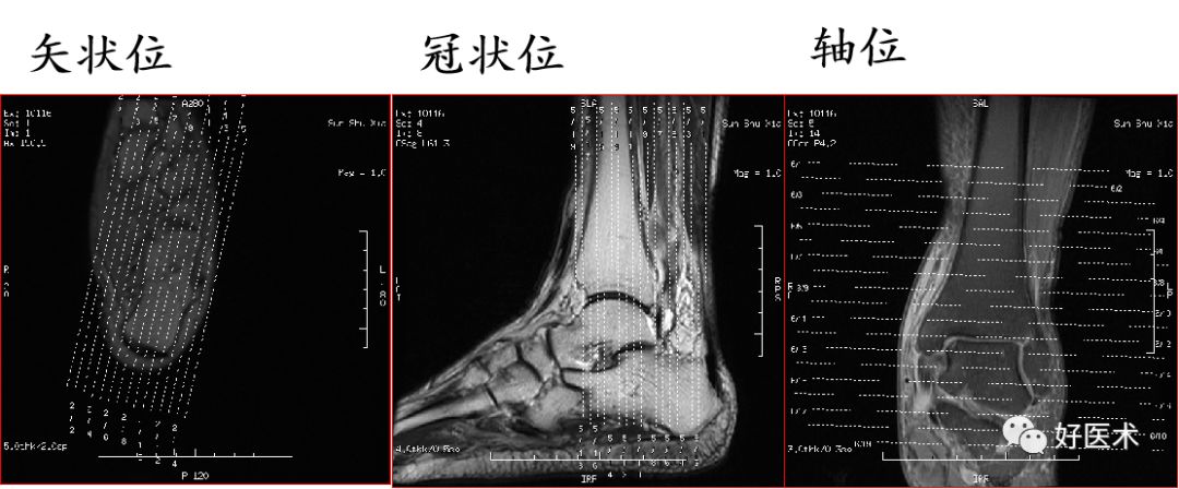 影像PPT - 踝关节MRI解剖与常见病变-11 影像PPT - 踝关节MRI解剖与常见病变-11