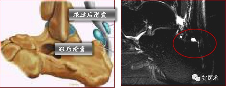 影像PPT - 踝关节MRI解剖与常见病变-27 影像PPT - 踝关节MRI解剖与常见病变-27