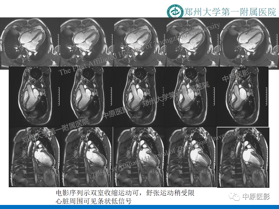 影像PPT - 【病例】缩窄性心包炎1例MR影像-4