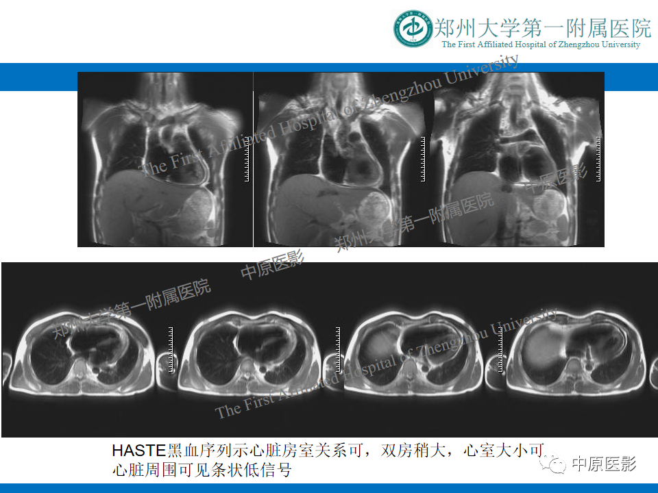 影像PPT - 【病例】缩窄性心包炎1例MR影像-3
