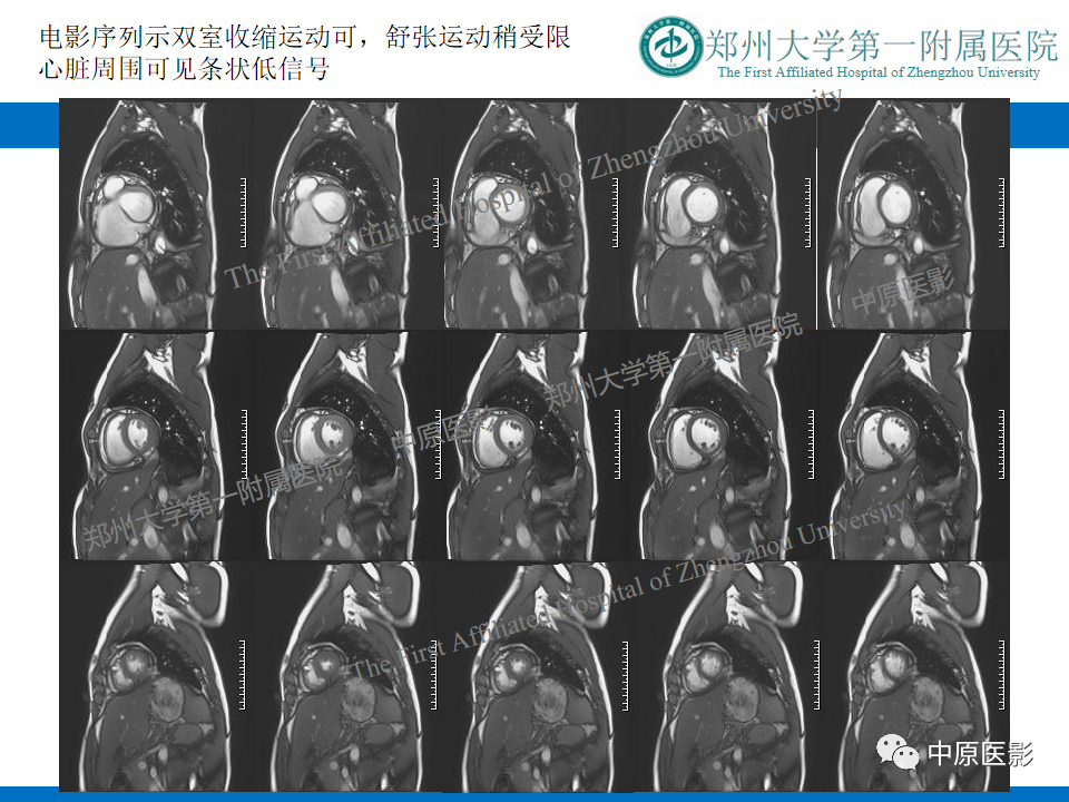影像PPT - 【病例】缩窄性心包炎1例MR影像-5