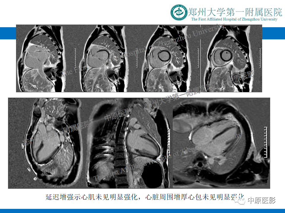 影像PPT - 【病例】缩窄性心包炎1例MR影像-7