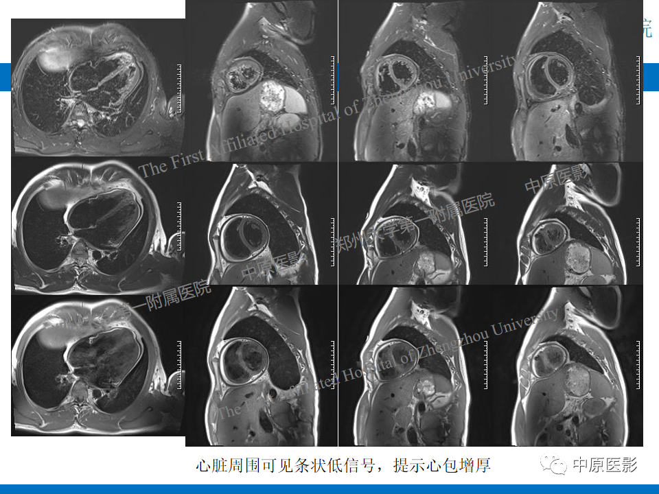 影像PPT - 【病例】缩窄性心包炎1例MR影像-6