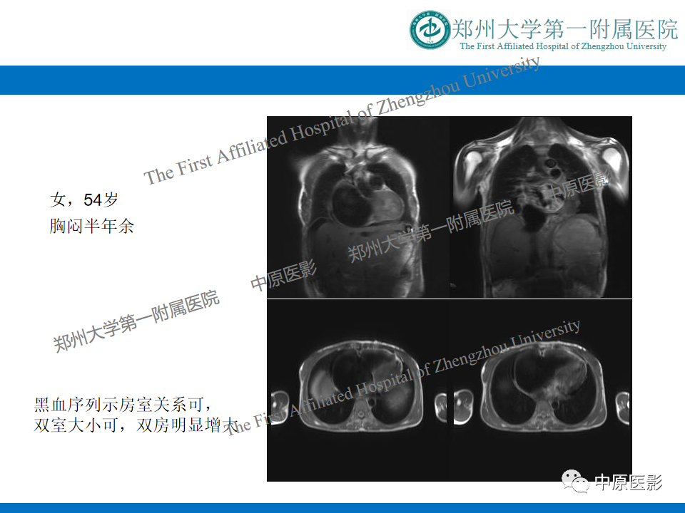 影像PPT - 【病例】缩窄性心包炎1例MR影像-16
