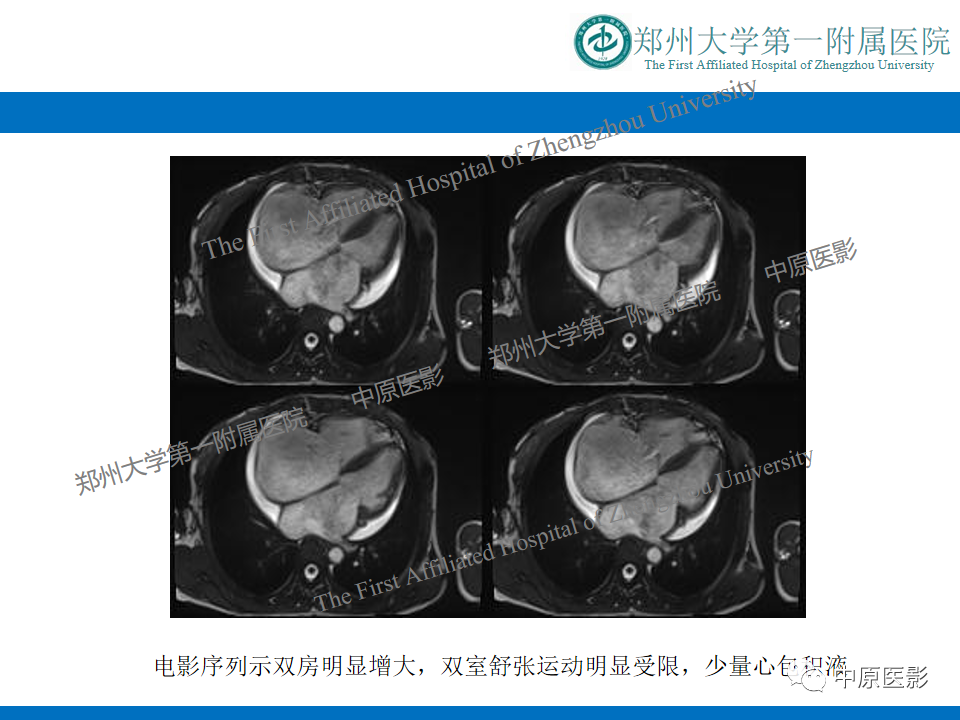 影像PPT - 【病例】缩窄性心包炎1例MR影像-17