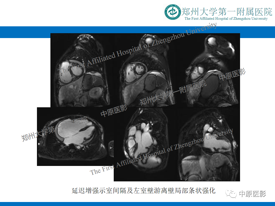 影像PPT - 【病例】缩窄性心包炎1例MR影像-18