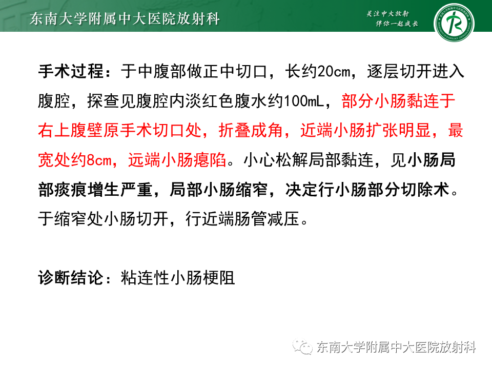 影像PPT - 【PPT】小肠梗阻的影像诊断-3