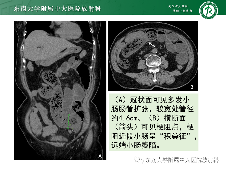 影像PPT - 【PPT】小肠梗阻的影像诊断-2