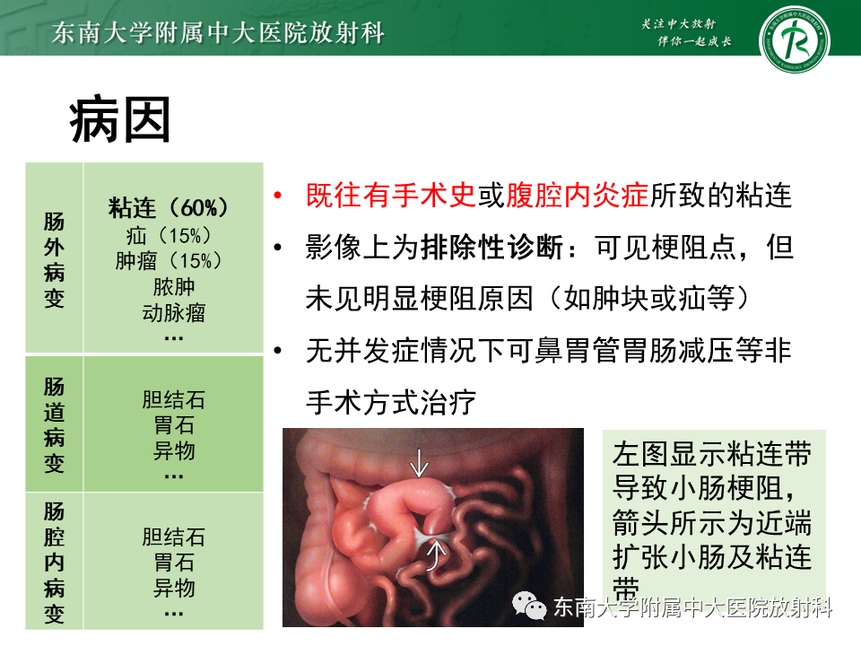 影像PPT - 【PPT】小肠梗阻的影像诊断-8