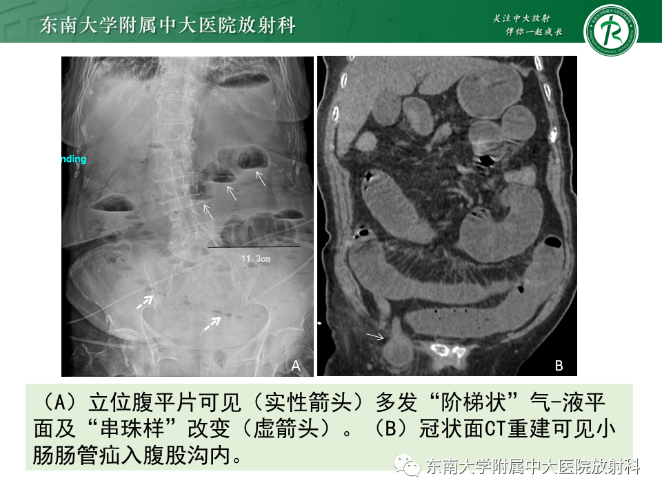 影像PPT - 【PPT】小肠梗阻的影像诊断-11