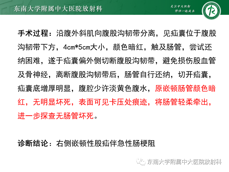 影像PPT - 【PPT】小肠梗阻的影像诊断-12