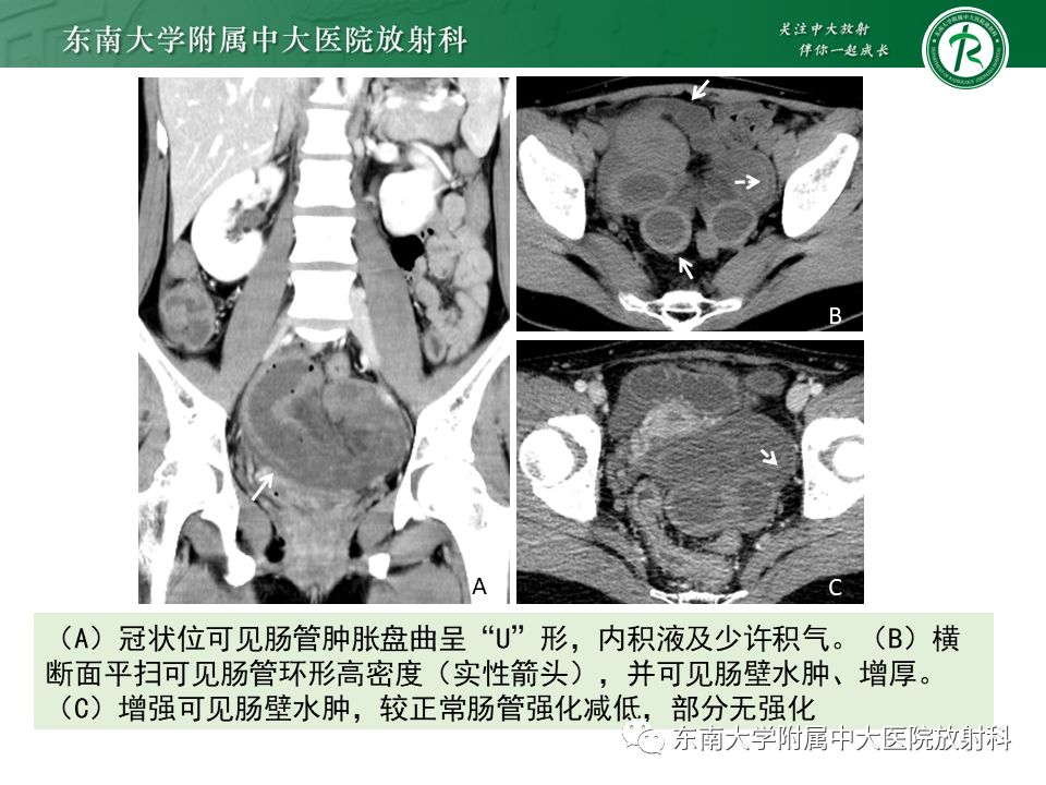 影像PPT - 【PPT】小肠梗阻的影像诊断-14