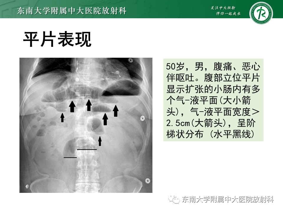 影像PPT - 【PPT】小肠梗阻的影像诊断-23