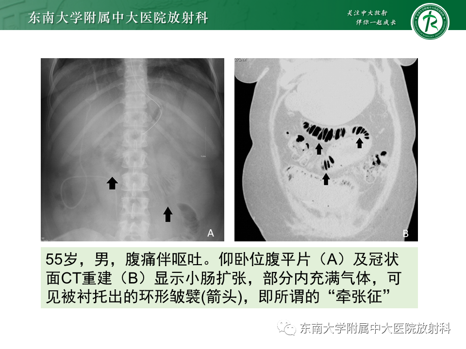 影像PPT - 【PPT】小肠梗阻的影像诊断-25