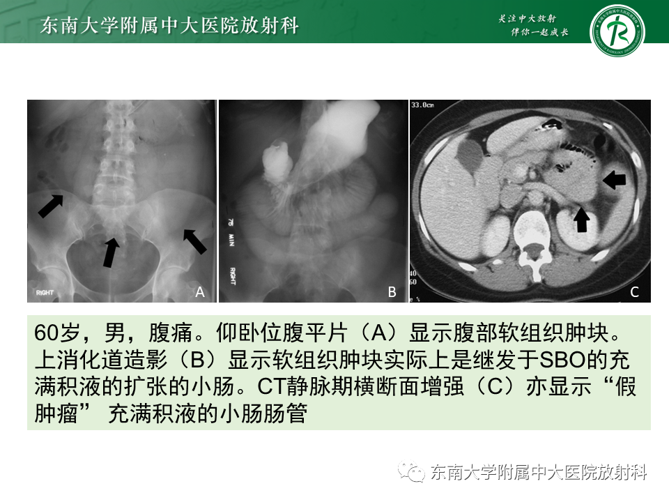 影像PPT - 【PPT】小肠梗阻的影像诊断-27