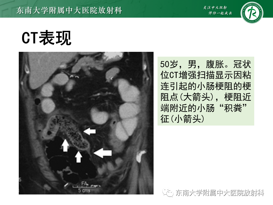 影像PPT - 【PPT】小肠梗阻的影像诊断-30