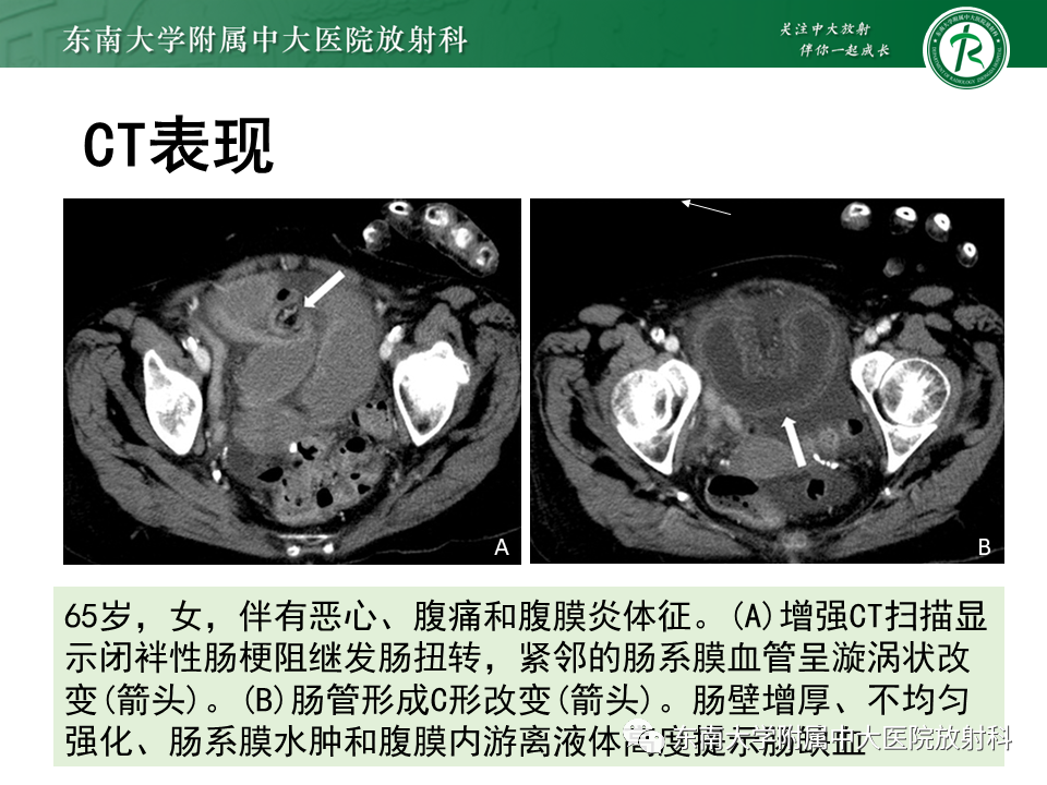 影像PPT - 【PPT】小肠梗阻的影像诊断-33