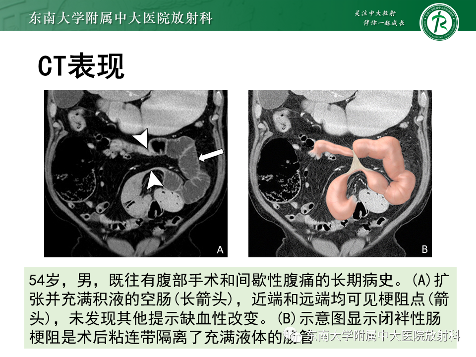 影像PPT - 【PPT】小肠梗阻的影像诊断-32