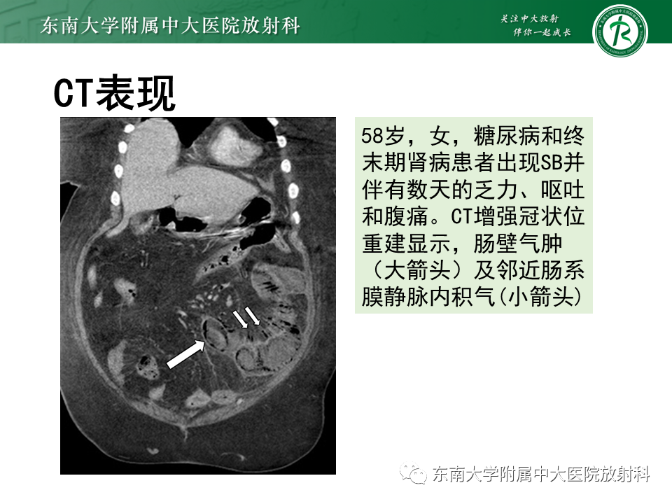 影像PPT - 【PPT】小肠梗阻的影像诊断-34