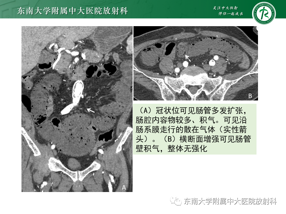 影像PPT - 【PPT】小肠梗阻的影像诊断-36