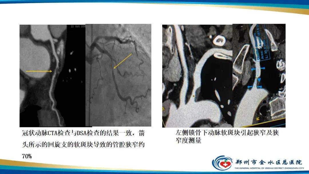 影像PPT - 【PPT】冠脉头颈一站式CTA联合扫描技术-6