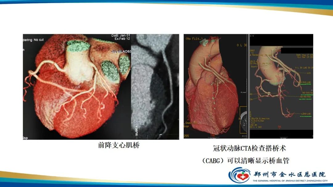 影像PPT - 【PPT】冠脉头颈一站式CTA联合扫描技术-8