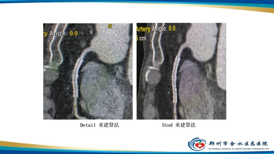 影像PPT - 【PPT】冠脉头颈一站式CTA联合扫描技术-27